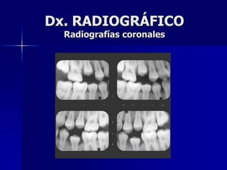 Dx. RADIOGRÁFICO
  Radiografías coronales
 