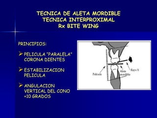 TECNICA DE ALETA MORDIBLE
         TECNICA INTERPROXIMAL
              Rx BITE WING


PRINCIPIOS:

 PELICULA “PARALELA”
  CORONA DIENTES

 ESTABILIZACION
  PELICULA

 ANGULACION
  VERTICAL DEL CONO
  +10 GRADOS
 