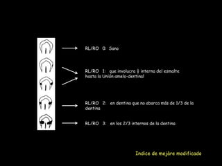 RL/RO 0: Sano




RL/RO 1: que involucra ½ interna del esmalte
hasta la Unión amelo-dentinal




RL/RO 2: en dentina que no abarca más de 1/3 de la
dentina


RL/RO 3: en los 2/3 internos de la dentina




                       Indice de mejàre modificado
 