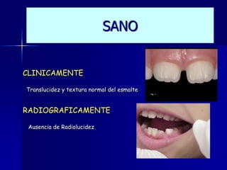 SANO


CLINICAMENTE

Translucidez y textura normal del esmalte


RADIOGRAFICAMENTE

 Ausencia de Radiolucidez
 