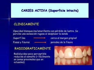 CARIES ACTIVA (Superficie intacta)



CLINICAMENTE

Opacidad blanquecina/amarillenta con pérdida de lustre. Se
percibe una sensación rugosa al desplazar la sonda
Superf lisa                         cerca al margen gingival
Fosas y fisuras                     paredes de la fisura

 RADIOGRAFICAMENTE
Radiolucidez poco perceptible
reducida al esmalte (+ fácilmente
en zonas proximales que en
oclusales)
 