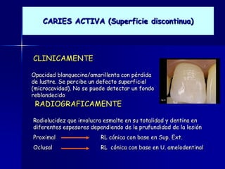 CARIES ACTIVA (Superficie discontinua)



CLINICAMENTE

Opacidad blanquecina/amarillenta con pérdida
de lustre. Se percibe un defecto superficial
(microcavidad). No se puede detectar un fondo
reblandecido
 RADIOGRAFICAMENTE

Radiolucidez que involucra esmalte en su totalidad y dentina en
diferentes espesores dependiendo de la prufundidad de la lesión
Proximal                 RL cónica con base en Sup. Ext.
Oclusal                  RL cónica con base en U. amelodentinal
 