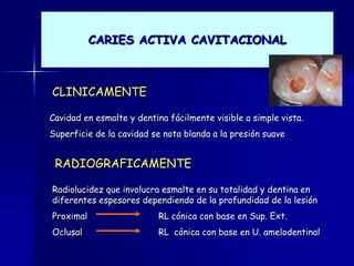 CARIES ACTIVA CAVITACIONAL



CLINICAMENTE

Cavidad en esmalte y dentina fácilmente visible a simple vista.
Superficie de la cavidad se nota blanda a la presión suave


 RADIOGRAFICAMENTE

Radiolucidez que involucra esmalte en su totalidad y dentina en
diferentes espesores dependiendo de la profundidad de la lesión
Proximal                   RL cónica con base en Sup. Ext.
Oclusal                    RL cónica con base en U. amelodentinal
 