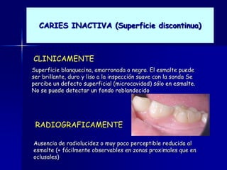 CARIES INACTIVA (Superficie discontinua)



CLINICAMENTE
Superficie blanquecina, amarronada o negra. El esmalte puede
ser brillante, duro y liso a la inspección suave con la sonda Se
percibe un defecto superficial (microcavidad) sólo en esmalte.
No se puede detectar un fondo reblandecido




 RADIOGRAFICAMENTE

Ausencia de radiolucidez o muy poco perceptible reducida al
esmalte (+ fácilmente observables en zonas proximales que en
oclusales)
 
