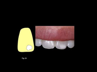 Diagnostico de caries (1) (1)