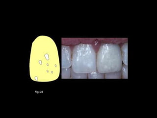 Diagnostico de caries (1) (1)