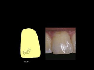 Diagnostico de caries (1) (1)
