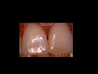 Diagnostico de caries (1) (1)
