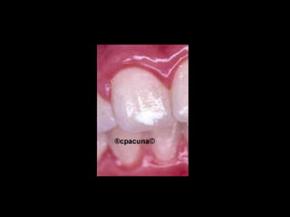 Diagnostico de caries (1) (1)