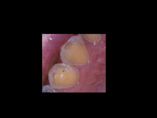 Diagnostico de caries (1) (1)