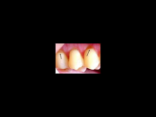 Diagnostico de caries (1) (1)