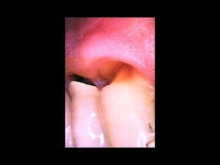 Diagnostico de caries (1) (1)