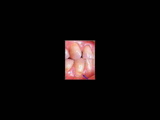 Diagnostico de caries (1) (1)