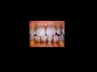 Diagnostico de caries (1) (1)