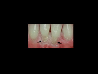 Diagnostico de caries (1) (1)