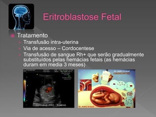  Tratamento
› Transfusão intra-uterina
› Via de acesso – Cordocentese
› Transfusão de sangue Rh+ que serão gradualmente
substituídos pelas hemácias fetais (as hemácias
duram em media 3 meses)
 