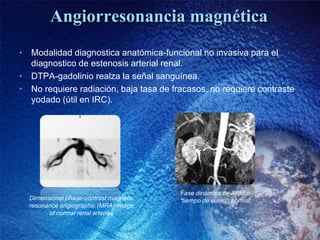 Angiorresonancia magnética
• Modalidad diagnostica anatómica-funcional no invasiva para el
  diagnostico de estenosis arte...