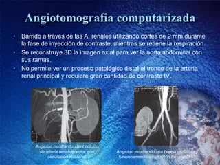 Angiotomografia computarizada
• Barrido a través de las A. renales utilizando cortes de 2 mm durante
  la fase de inyecció...