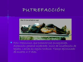PUTREFACCIÓNPUTREFACCIÓN
 Foto: Masculino, que presenta piel ennegrecida,Foto: Masculino, que presenta piel ennegrecida,
distensión gaseosa moderada. Inicio de licuefacción dedistensión gaseosa moderada. Inicio de licuefacción de
tejidos. Larvas en región torácica. Tiempo aproximadotejidos. Larvas en región torácica. Tiempo aproximado
de muerte: 6-7 días.de muerte: 6-7 días.
 