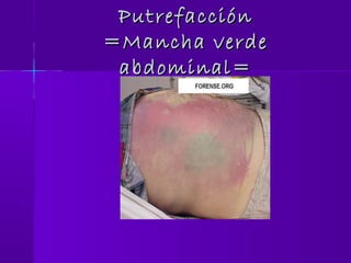 PutrefacciónPutrefacción
=Mancha verde=Mancha verde
abdominal=abdominal=
 