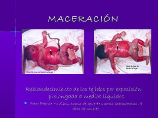 MACERACIÓNMACERACIÓN
Reblandecimiento de los tejidos por exposiciónReblandecimiento de los tejidos por exposición
prolongada a medios líquidosprolongada a medios líquidos
 Foto: Feto de 41 SDG, causa de muerte anoxia intrauterina, 4Foto: Feto de 41 SDG, causa de muerte anoxia intrauterina, 4
días de muerto.días de muerto.
 