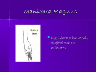 Maniobra MagnusManiobra Magnus
 Ligadura o isquemiaLigadura o isquemia
digital por 10digital por 10
minutos.minutos.
 