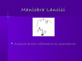 Maniobra LancisiManiobra Lancisi
 Ausencia de halo inflamatorio en quemadurasAusencia de halo inflamatorio en quemaduras
 