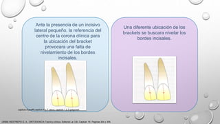 Ante la presencia de un incisivo
lateral pequeño, la referencia del
centro de la corona clínica para
la ubicación del bracket
provocara una falta de
nivelamiento de los bordes
incisales.
Una diferente ubicación de los
brackets se buscara nivelar los
bordes incisales.
URIBE RESTREPO G. A., ORTODONCIA Teoría y clínica, Editorial La CIB, Capitulo 16, Paginas 304 y 305.
capitulo 6 proffit,capitulo 6 y 7 canut, capitulo 1,2,3 gregroret
 