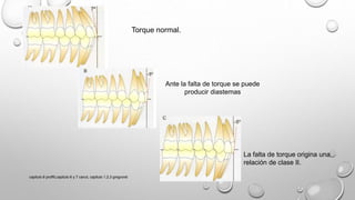 Torque normal.
Ante la falta de torque se puede
producir diastemas
La falta de torque origina una
relación de clase II.
capitulo 6 proffit,capitulo 6 y 7 canut, capitulo 1,2,3 gregroret
 