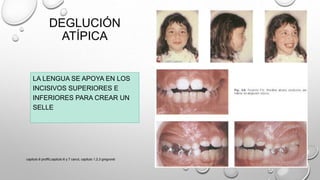 DEGLUCIÓN
ATÍPICA
LA LENGUA SE APOYA EN LOS
INCISIVOS SUPERIORES E
INFERIORES PARA CREAR UN
SELLE
capitulo 6 proffit,capitulo 6 y 7 canut, capitulo 1,2,3 gregroret
 