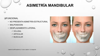 ASIMETRÍA MANDIBULAR
FUNCIONAL
• NO PRESENTA ASIMETRÍA ESTRUCTURAL
• MALPOSICION
• DESPLAZAMIENTO LATERAL
 OCLUSAL
 ARTICULAR
 MUSCULAR
capitulo 6 proffit,capitulo 6 y 7 canut, capitulo 1,2,3 gregroret
 