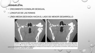 ESQUELETAL
• CRECIMIENTO CONDILAR DESIGUAL
• LONGITUD DE LAS RAMAS
• LÍNEA MEDIA DESVIADA HACIA EL LADO DE MENOR DESARROLLO
capitulo 6 proffit,capitulo 6 y 7 canut, capitulo 1,2,3 gregroret
 