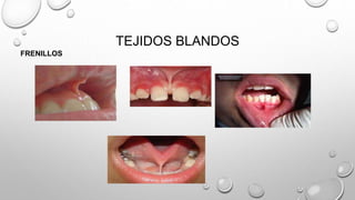 TEJIDOS BLANDOS
FRENILLOS
 