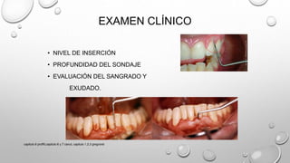 EXAMEN CLÍNICO
• NIVEL DE INSERCIÓN
• PROFUNDIDAD DEL SONDAJE
• EVALUACIÓN DEL SANGRADO Y
EXUDADO.
capitulo 6 proffit,capitulo 6 y 7 canut, capitulo 1,2,3 gregroret
 