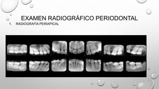 EXAMEN RADIOGRÁFICO PERIODONTAL
1. RADIOGRAFÍA PERIAPICAL
 