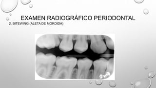 EXAMEN RADIOGRÁFICO PERIODONTAL
2. BITEWING (ALETA DE MORDIDA)
 