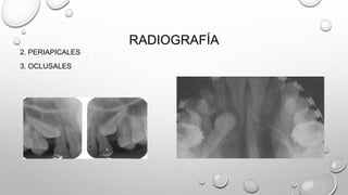 RADIOGRAFÍA
2. PERIAPICALES
3. OCLUSALES
 