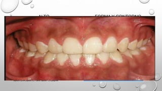 ALTO
Altura
gingival
proporcional
IC y
canino
elevado
IL 1.5 mm
abajo
FORMA Y CONTORNO
Curvatura de la encía
en el margen de los
dientes
IL ovalada, punto cenit
eje axial del diente
IC canino elíptica,
punto cenit distal al eje
del diente
capitulo 6 proffit,capitulo 6 y 7 canut, capitulo 1,2,3 gregroret
 