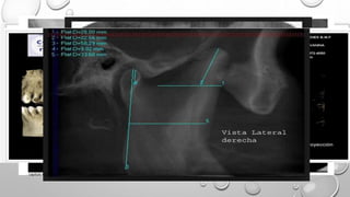 SALUD DE LOS DIENTES Y ESTRUCTURAS
BUCALES
RX INTRABUCALES:
(RUTINA TTO
ORTODONTICOS
COMPLEJO)
RX PANORAMICA
RX PERIAPICAL Y
ALETA DE MORDIDA
TOMOGRAFIA
COMPUTARIZADA
HAZ CONICO 3D
(localización caninos)
Rx de la articulacion
TM
capitulo 6 proffit,capitulo 6 y 7 canut, capitulo 1,2,3 gregroret
 