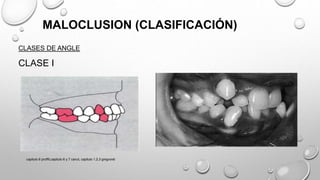 MALOCLUSION (CLASIFICACIÓN)
CLASES DE ANGLE
CLASE I
capitulo 6 proffit,capitulo 6 y 7 canut, capitulo 1,2,3 gregroret
 