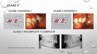 CLASE II
CLASE II DIVISIÓN 1 CLASE II DIVISIÓN 2
CLASE II INCOMPLETA Y COMPLETA
capitulo 6 proffit,capitulo 6 y 7 canut, capitulo 1,2,3 gregroret
 