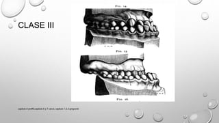 CLASE III
capitulo 6 proffit,capitulo 6 y 7 canut, capitulo 1,2,3 gregroret
 