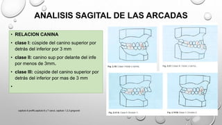 • RELACION CANINA
• clase l: cúspide del canino superior por
detrás del inferior por 3 mm
• clase ll: canino sup por delante del infe
por menos de 3mm.
• clase lll: cúspide del canino superior por
detrás del inferior por mas de 3 mm
•
ANALISIS SAGITAL DE LAS ARCADAS
capitulo 6 proffit,capitulo 6 y 7 canut, capitulo 1,2,3 gregroret
 