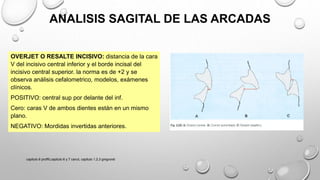 OVERJET O RESALTE INCISIVO: distancia de la cara
V del incisivo central inferior y el borde incisal del
incisivo central superior. la norma es de +2 y se
observa análisis cefalometrico, modelos, exámenes
clínicos.
POSITIVO: central sup por delante del inf.
Cero: caras V de ambos dientes están en un mismo
plano.
NEGATIVO: Mordidas invertidas anteriores.
ANALISIS SAGITAL DE LAS ARCADAS
capitulo 6 proffit,capitulo 6 y 7 canut, capitulo 1,2,3 gregroret
 
