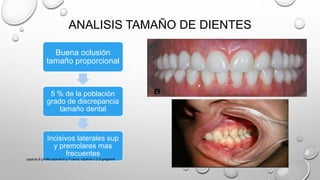 ANALISIS TAMAÑO DE DIENTES
Buena oclusión
tamaño proporcional
5 % de la población
grado de discrepancia
tamaño dental
Incisivos laterales sup
y premolares mas
frecuentes
capitulo 6 proffit,capitulo 6 y 7 canut, capitulo 1,2,3 gregroret
 