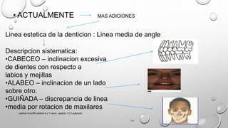 • ACTUALMENTE MAS ADICIONES
Linea estetica de la denticion : Linea media de angle
Descripcion sistematica:
•CABECEO – inclinacion excesiva
de dientes con respecto a
labios y mejillas
•ALABEO – inclinacion de un lado
sobre otro.
•GUIÑADA – discrepancia de linea
•media por rotacion de maxilares
capitulo 6 proffit,capitulo 6 y 7 canut, capitulo 1,2,3 gregroret
 