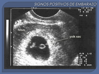 SIGNOS POSITIVOS DE EMBARAZOSIGNOS POSITIVOS DE EMBARAZO
 