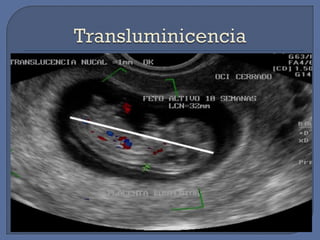 Diagnostico embarazo