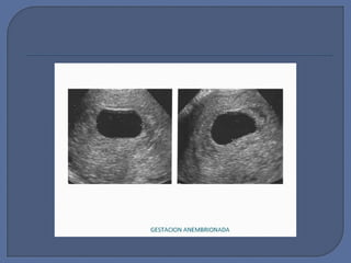 Diagnostico embarazo