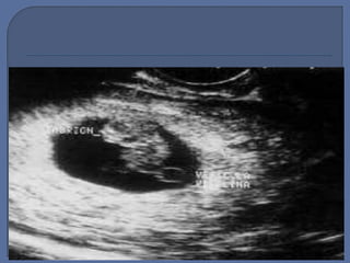 Diagnostico embarazo